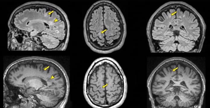 Consensus européen autour de l'adoption clinique des QReports pour l'IRM de la SEP