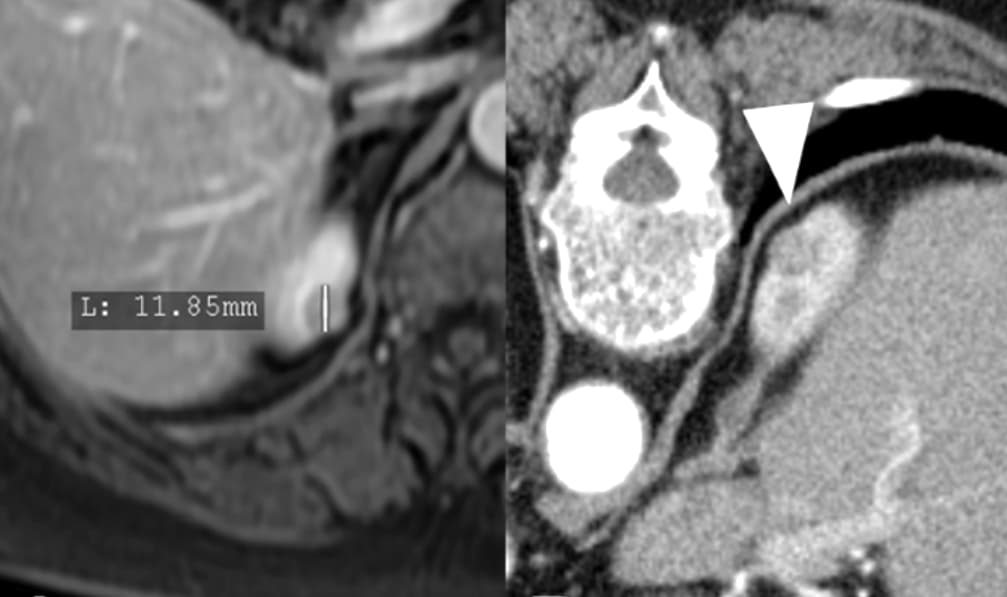 Traitement percutané des tumeurs rénales : les recommandations diffèrent en Europe et aux USA