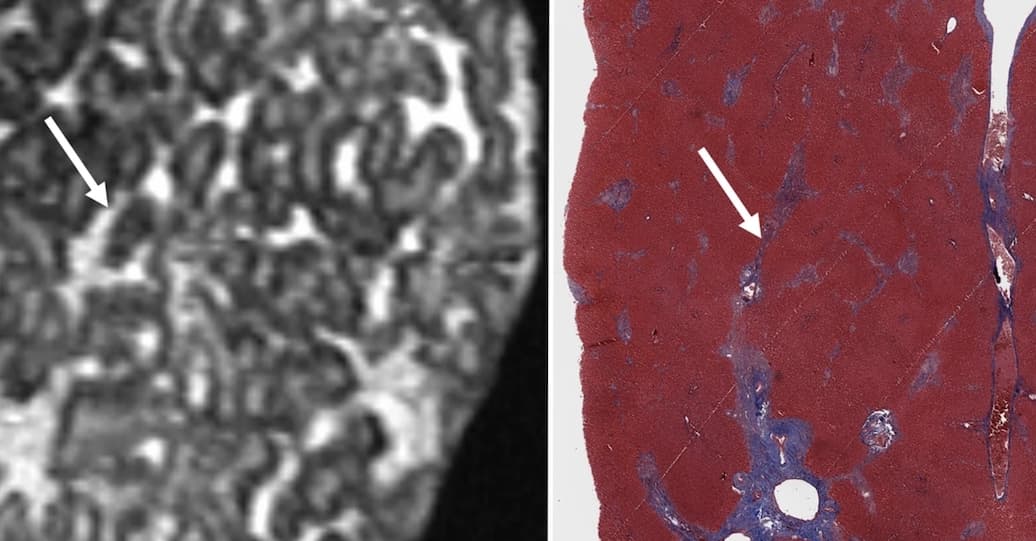 Illustration L'IRM 7T comme alternative à l'histopathologie pour l'étude de la fibrose hépatique ex vivo