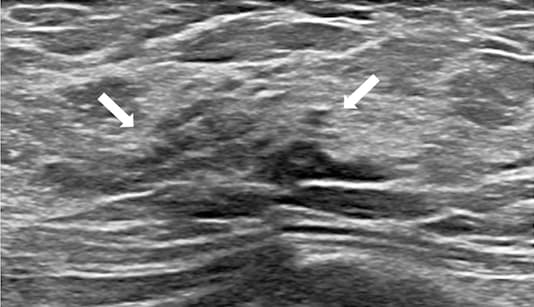 Illustration Un agrément inter-observateurs pour diagnostiquer les nodules mammaires