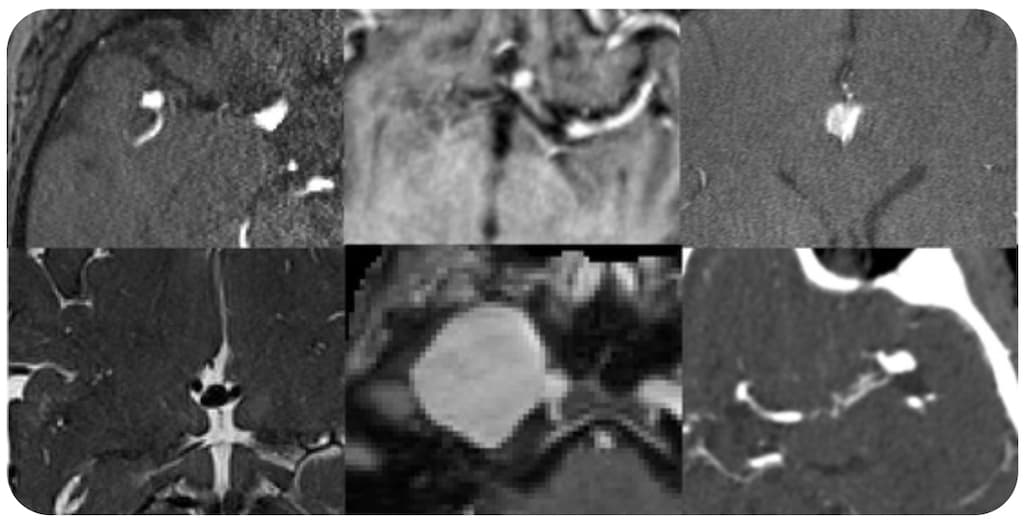 Le RSNA AI Challenge 2025 a rendu son verdict