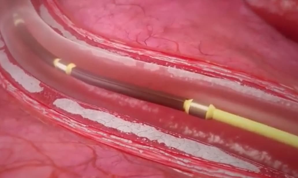 La lithotripsie intravasculaire se démocratise