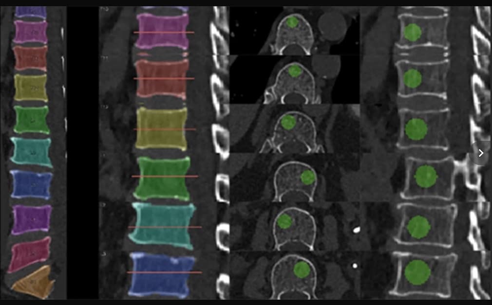 Illustration Dépistage opportuniste de fracture par TDM quantitative dans le cadre d'une déminéralisation osseuse