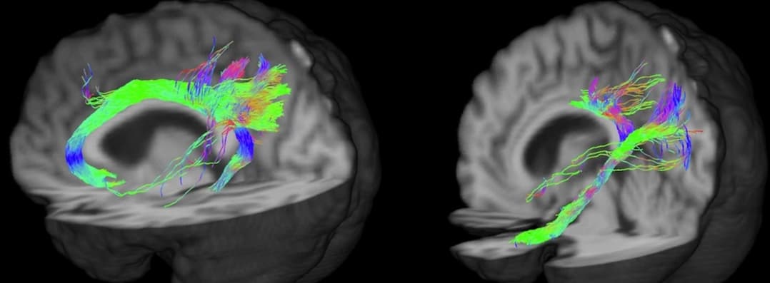 Illustration Des protocoles de tractographie IRM, un espoir pour mieux explorer le cerveau dans le maladie d'Alzheimer