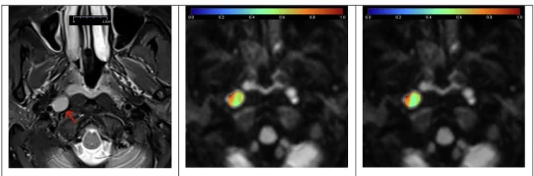 De nouveaux modèles d'IRM de diffusion pour distinguer les ganglions lymphatiques bénins et métastatiques cervicaux