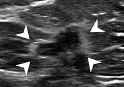 La 6ème édition de BI-RADS pourrait s'enrichir d'un nouveau critère
