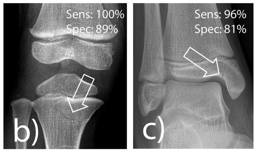 Une IA dédiée pour identifier les fractures en radiologie pédiatrique