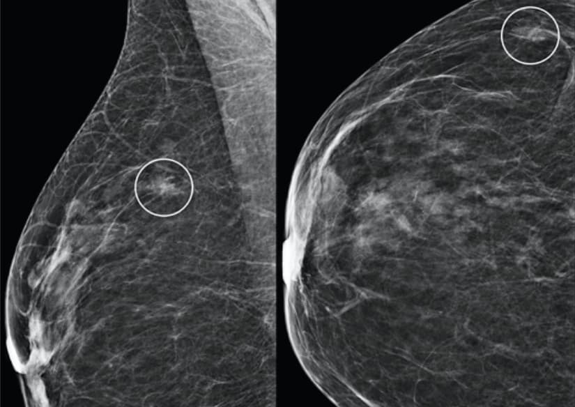 Comment interpréter le niveau intermédiaire de risque donné par l'IA dans le dépistage du cancer du sein ?
