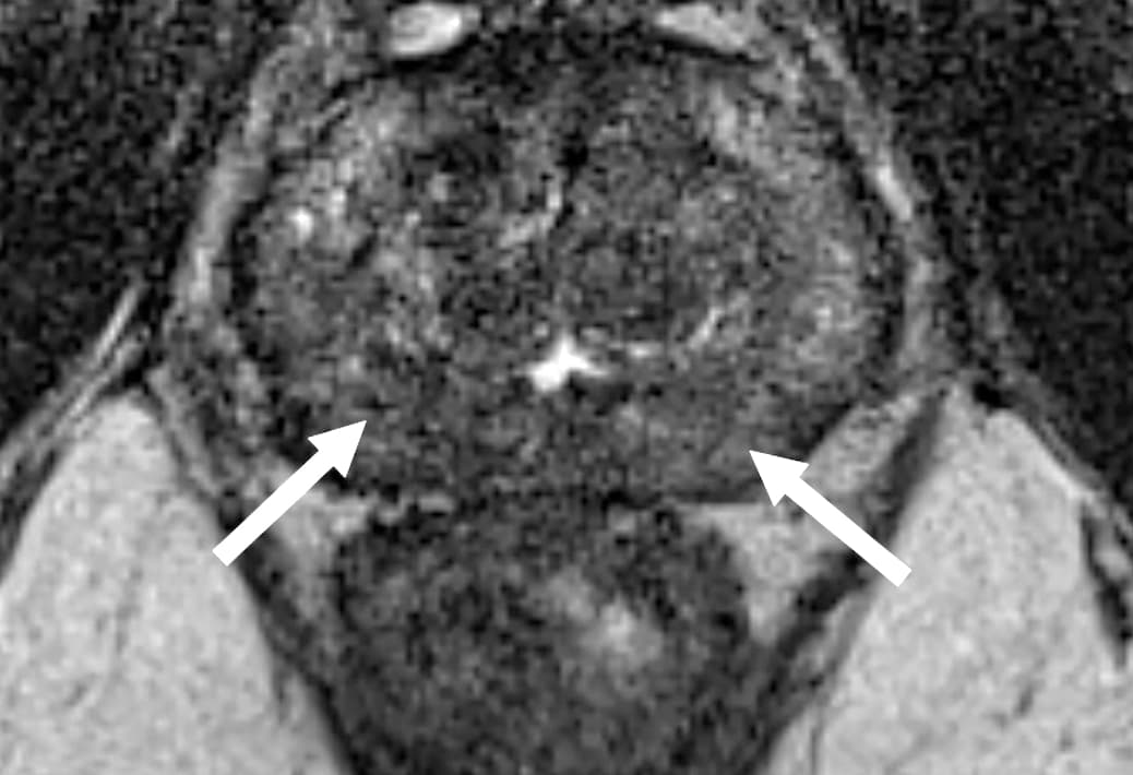 Quand et comment utiliser PI-RR et PI-RADS après traitement du cancer de la prostate ?
