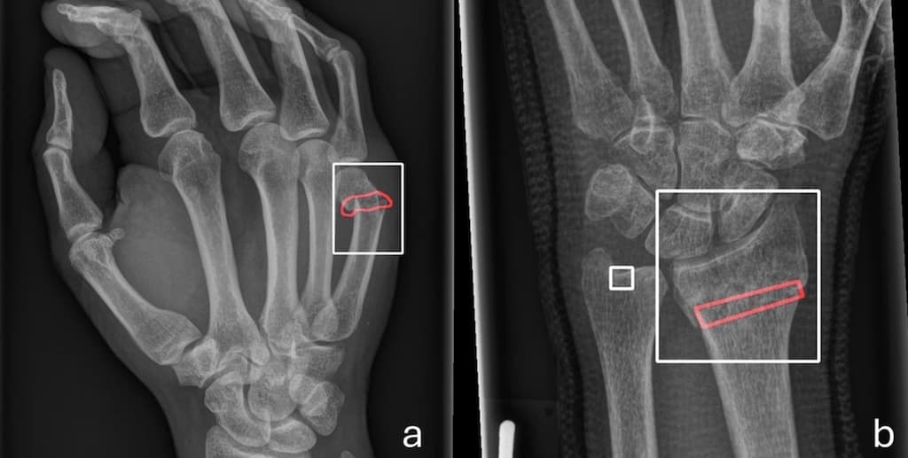 Une IA entraînée sur des cohortes hétérogènes est plus performante pour identifier les fracture en radiographie