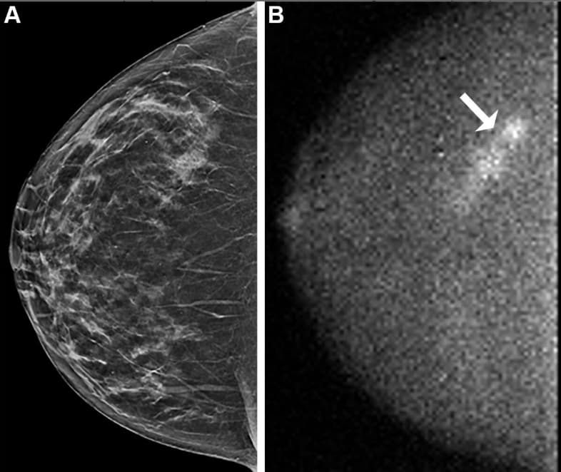 Une nouvelle étude plébiscite l'imagerie moléculaire en complément du dépistage du cancer du sein dense