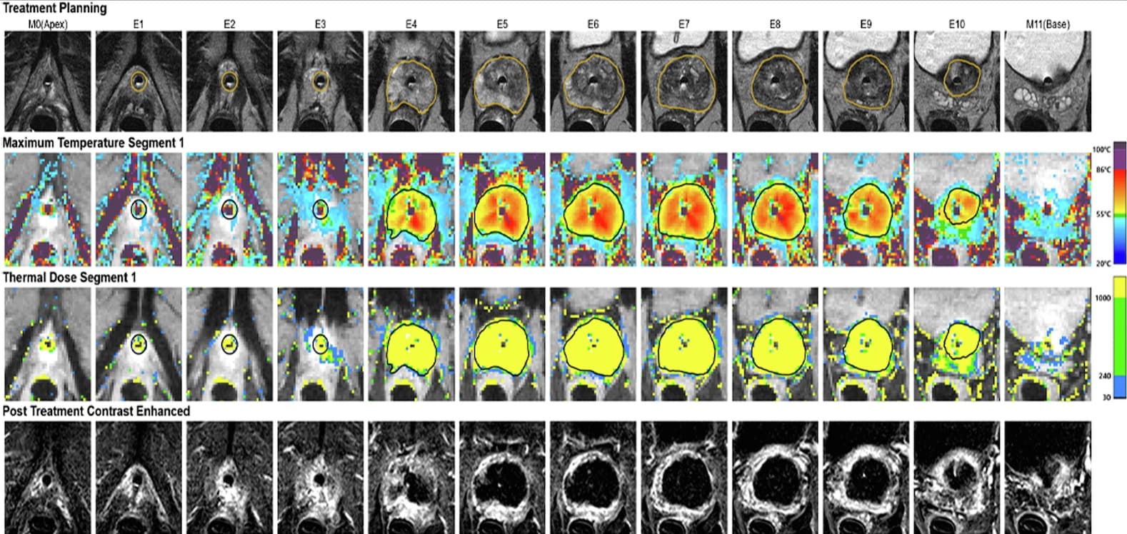 La TULSA guidée par IRM pour traiter le cancer de la prostate localisé