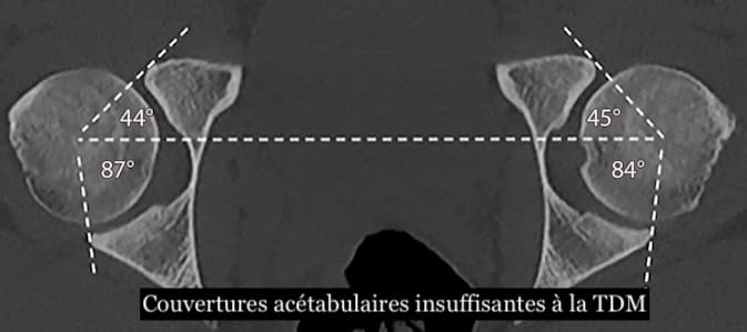 Un guide complet en imagerie multimodale de l'instabilité de hanche